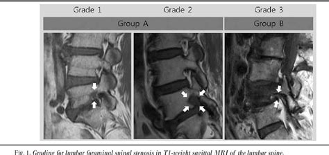 Figure From Outcome Of Transforaminal Epidural Steroid Injection