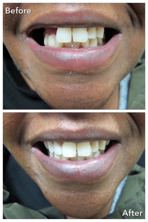 Partial Denture Treatment - Baker Lanoue Denture Clinic