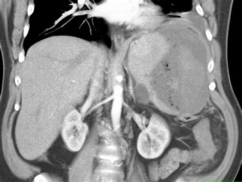 Splenic Hematoma Ultrasound