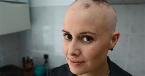 Woman With Alopecia Opens Up About The Difficulties Of Dating It Has