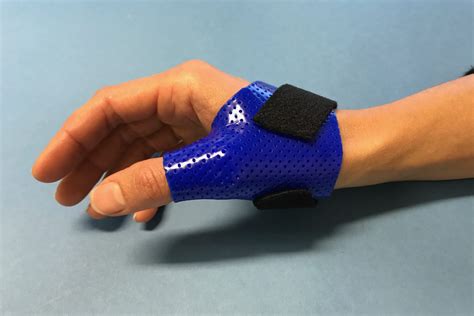 Dupuytren's Contracture Splint : 02. Dupuytrens Surgery - Dupuytren's ...