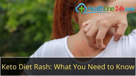 Keto Diet Rash What You Need To Know Youtube