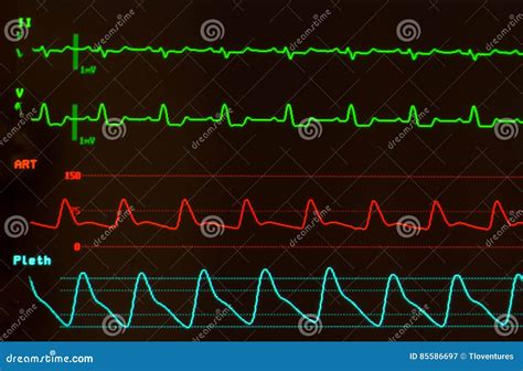 Heart Monitor with Intraventricular Conduction Delay on EKG Stock Image ...