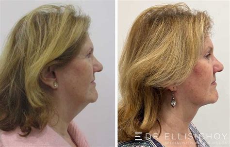 Myellevate Sydney Non Surgical Neck Lift