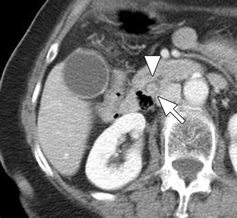 Mr Imaging And Ct Of The Biliary Tract Radiographics