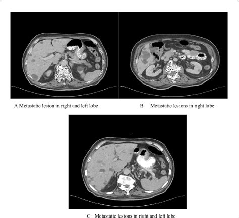 Multipl Metastatic Lesions Are Seen In Left And Right Lobes Of The