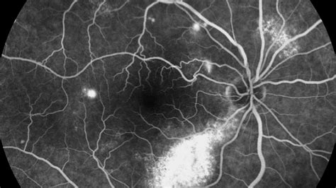 Understanding The Role Of Fluorescein Angiogram In Retinal Health