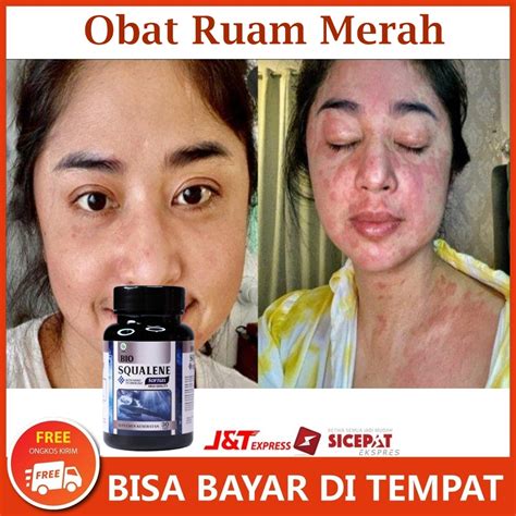 Jual Bio Squalene Softgel Obat Ruam Merah Penghilang Ruam Kulit