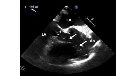 Echocardiographic Mid Esophageal Aortic Valve Long Axis View The Tip