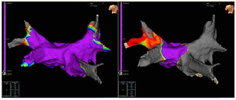 JCDD Free Full Text Adding Electroanatomical Mapping To Cryoballoon