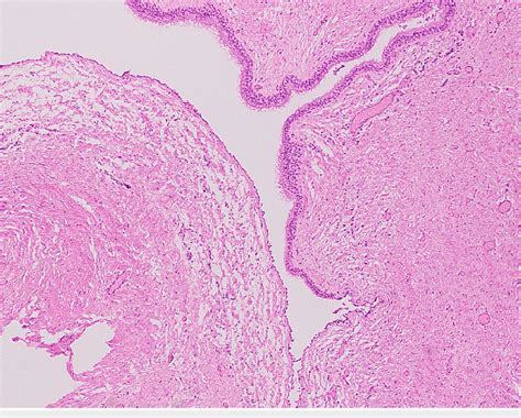 Low Power View Of Cyst Showing Ciliated Epithelium Download