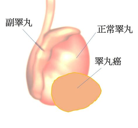 「搗蛋」腫瘤──睪丸癌 陰囊腫脹響警號 年輕男士須留神 明報新聞網