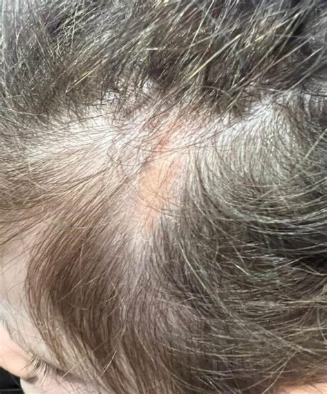 Nevus Sebaceous On Scalp