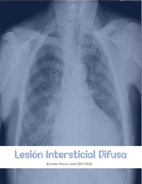 Lesi N Intersticial Difusa Breenstudy Udocz