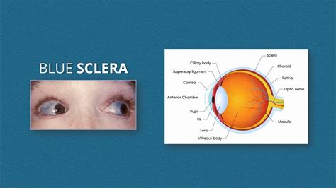 Blue Sclera Pathology And Its Causes Remember Mnemonic Blue Is A Happy Poem Youtube