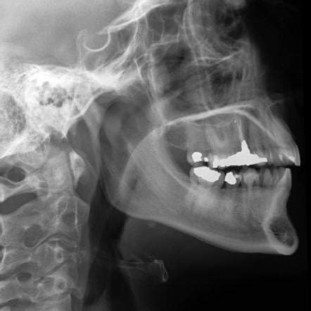 Submandibular Duct Radiology Reference Article Radiopaedia Org