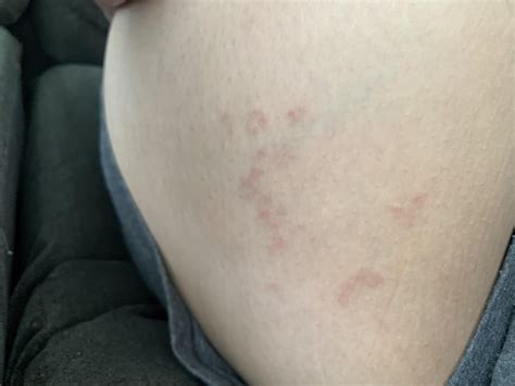 Skin Rash Inner Thigh R Dermatologyquestions