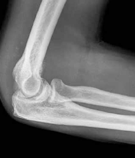 Lateral Radiograph Of Elbow Shows Calcifications Anterior And Posterior