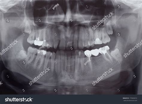 Human Teeth Xray Stock Photo 175969412 - Shutterstock