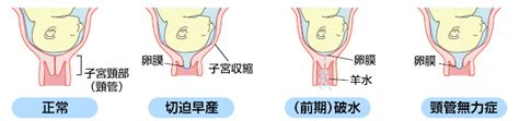 早産・切迫早産｜公益社団法人 日本産科婦人科学会