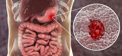 Hemorragia Interna En El Abdomen
