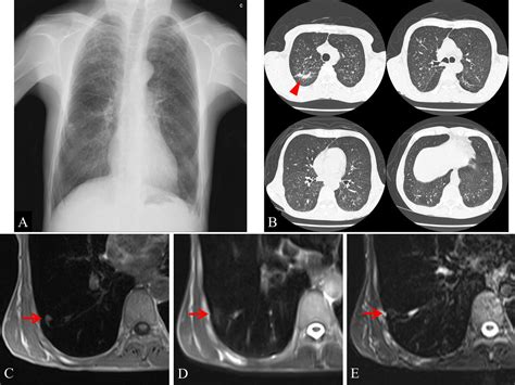 Cerebrotendinous Xanthomatosis With Radiological Abnormalities Of The Chest Bmj Case Reports