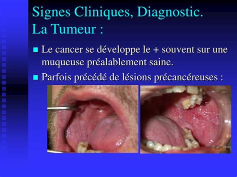 PPT CANCERS DE LA CAVITÉ BUCCALE OROPHARYNX PowerPoint Presentation