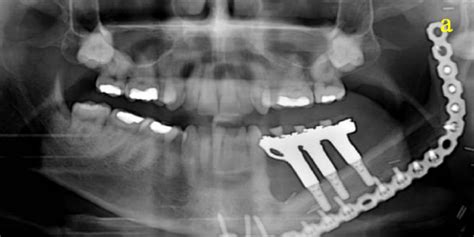 135 Surgical Resection Of Cancer Of The Buccal Mucosa Medicine