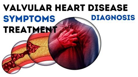 Valvular Heart Disease Symptoms Causes Treatment Youtube