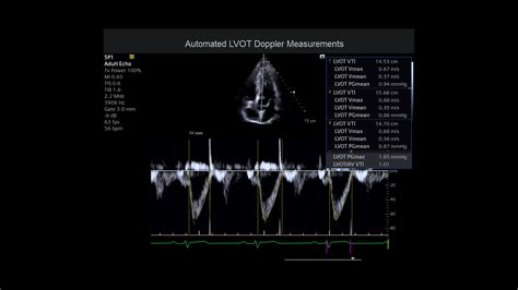 Acuson Juniper Cv Edition Ultrasound System Siemens Healthineers