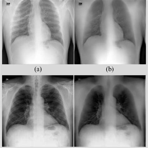 Bone Suppressed Images Predicted By The F Eb Bs Model Using Instances