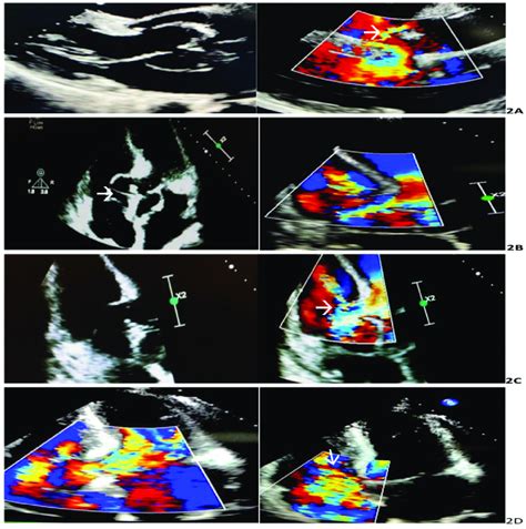 Transthoracic Echocardiography Showing Metallic Valve Endocarditis A