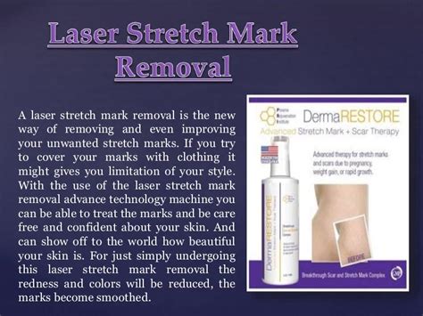 Laser stretch mark removal