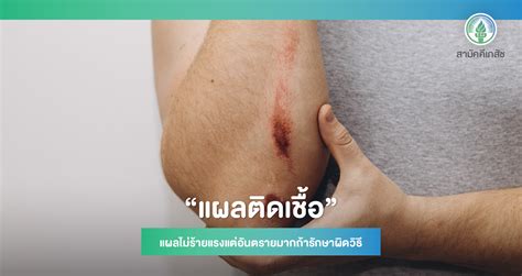 เป็นแผลถลอก มีหนอง ต้องทำไง สามัคคีเภสัช