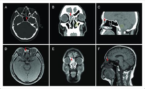 A C Ct Scan Showed Soft Tissue Signal Arrow In The Right Frontal