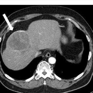 Abdominal Computed Tomography CT Images Contrast Enhanced Computed