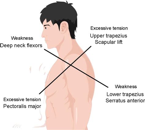 Exploring The Latest Advancements In Physical Therapy Techniques For Treating Cervical