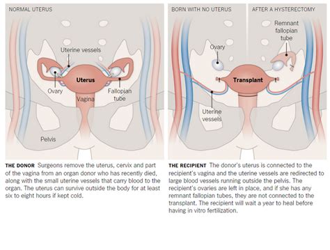 Fertility For Infertile Women Uterus Transplant Clinical And Molecular Dx