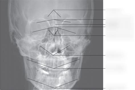 Skull Anteroposterior Radiograph Diagram Quizlet