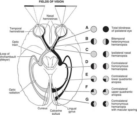 Cranial Nerve 2 Optic Nerve