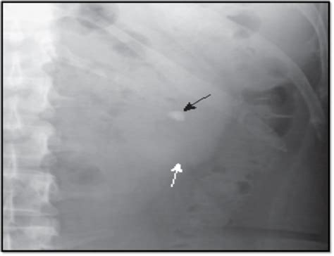 Abdomen Radiology Flashcards Quizlet