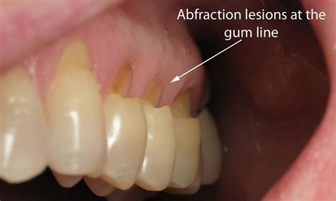 Tooth Abfraction Treatment