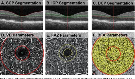 Figure 1 From Racial Differences In Quantitative Optical Coherence