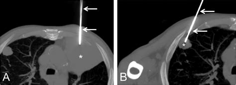 Bilateral Ct Guided Core Needle Lung Biopsy In A Lung Cancer Patient