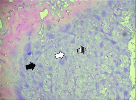 Case 2 Histopathology Of The Resected Specimen Hematoxylin Eosin