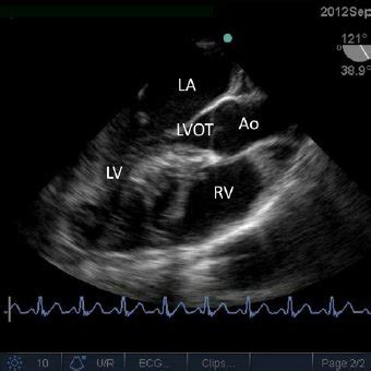 Midesophageal Aortic Valve Short Axis View Av Aortic Valve Bpm