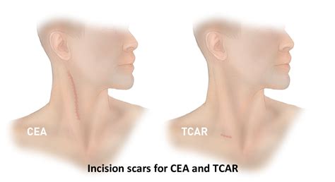 Transcarotid Artery Revascularization TCAR Oaklawn Hospital