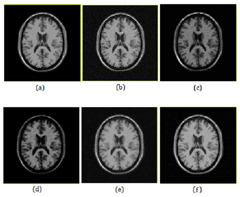 Denoising Of Multiple Coil MRI A Noise Free MRI B Noisy MRI