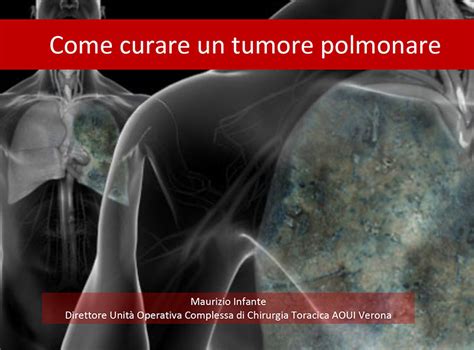 Come Curare Un Tumore Polmonare Dr Maurizio Infante