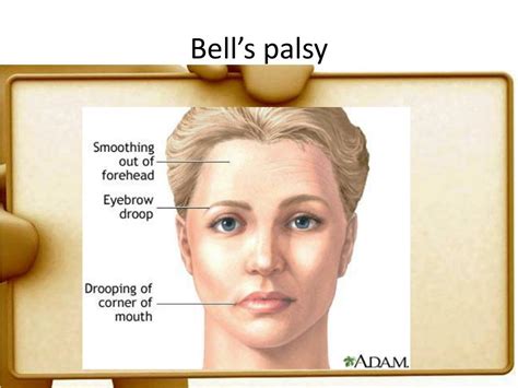 Ppt Bells Palsy Powerpoint Presentation Free Download Id2184905